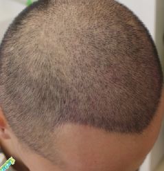 -大麦微针植发丨全国连锁