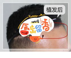 -大麦微针植发全国连锁