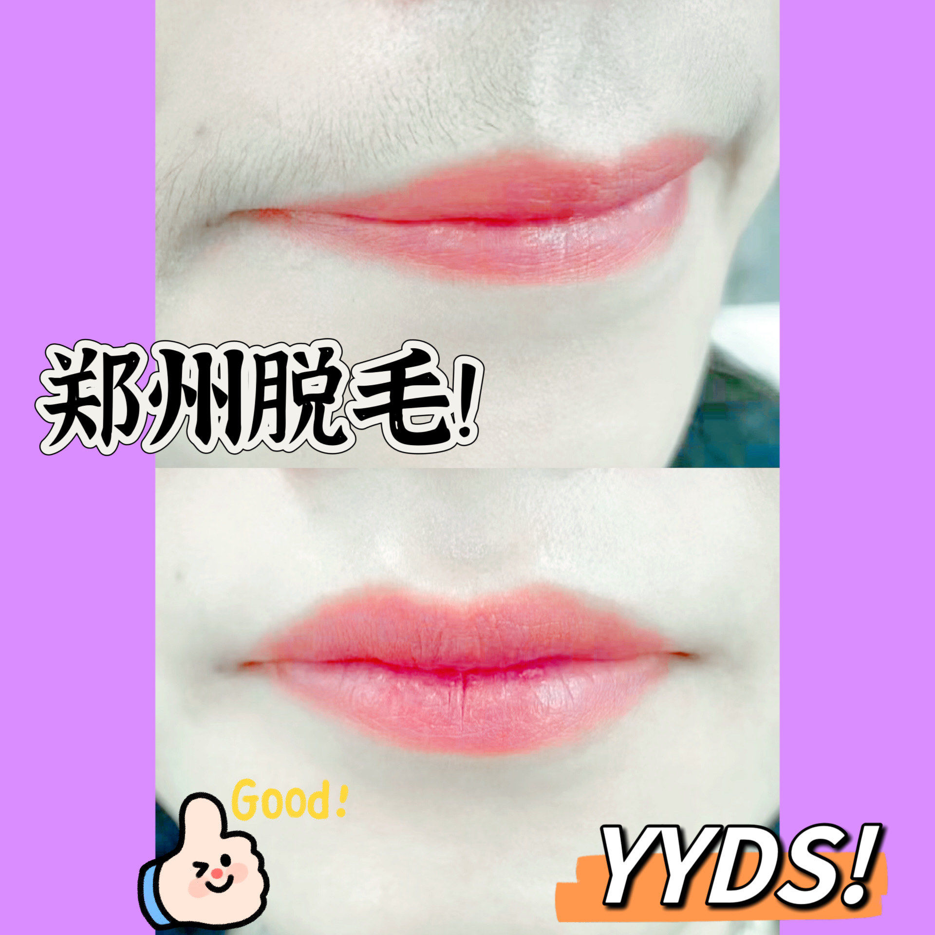 唇部脱毛效果对比90超喜欢00[加油][加油]