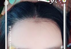 -大麦微针植发全国连锁