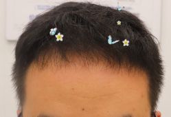 -大麦微针植发全国连锁