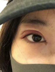 体验后-西安壹加壹医疗美容·西北抗衰旗舰店