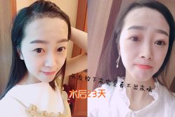 -大麦微针植发丨全国连锁