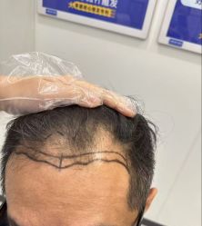 -大麦微针植发全国连锁