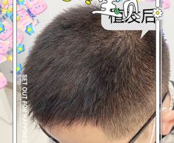 -大麦微针植发全国连锁