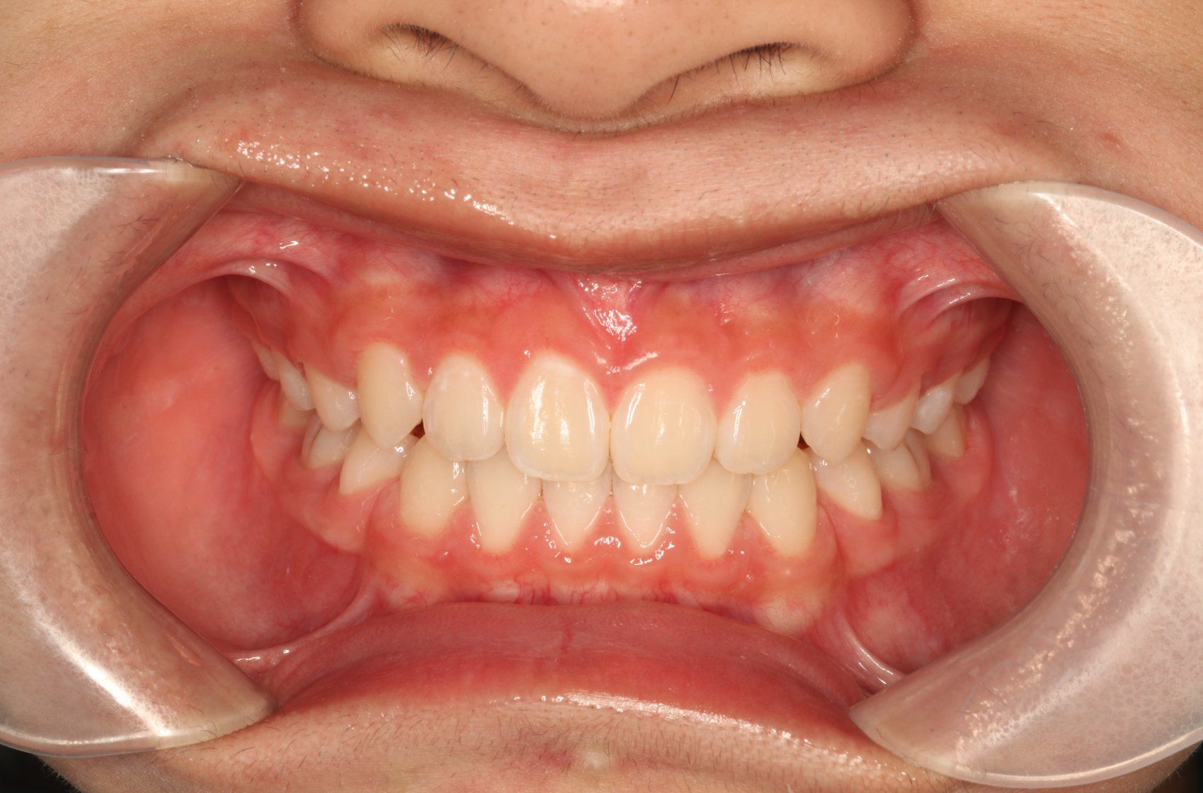 瑞欧齿科,解锁明星同款舌侧矫正秘籍✨