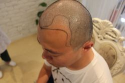 点击看大图 -大麦微针植发丨全国连锁