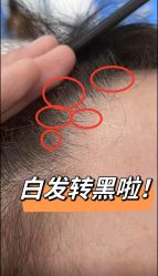 -菩叶脱发白发中心