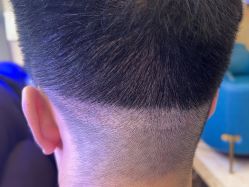 -碧莲盛·不剃发植发