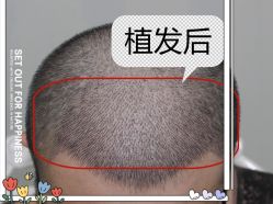 -大麦微针植发全国连锁