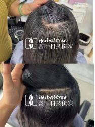 -菩叶脱发白发中心
