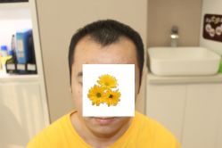 -大麦微针植发丨全国连锁