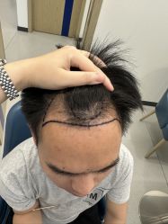 -大麦微针植发全国连锁