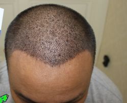 -大麦微针植发丨全国连锁