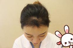 -大麦微针植发丨全国连锁