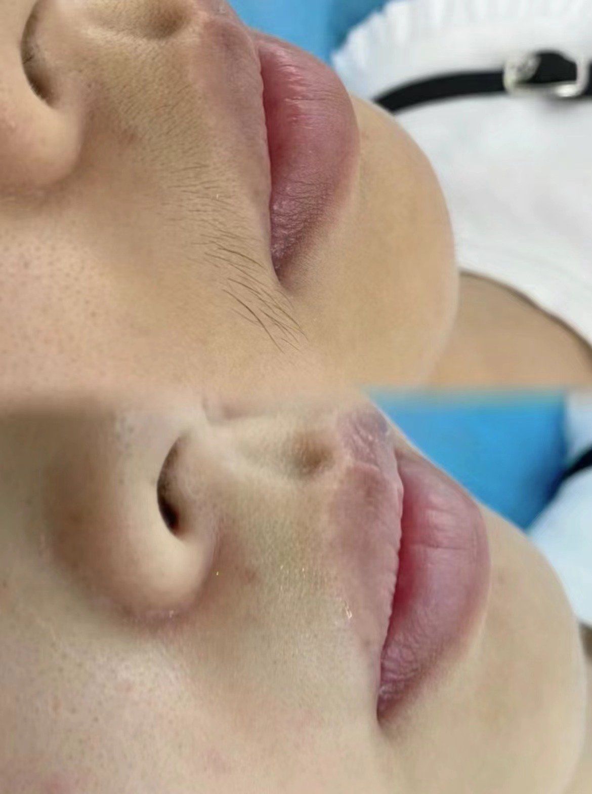 唇部脱毛对比图
精致不是一点点
