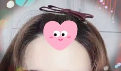 -大麦微针植发全国连锁