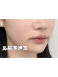 体验后-杭州米兰柏羽医疗美容医院