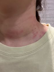 体验后-亿美医疗美容·半岛大超炮官方授权店
