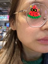 体验后-More摩尔医美の注射线雕光电中心