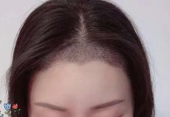 -大麦微针植发丨全国连锁