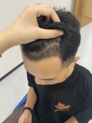 -大麦微针植发全国连锁