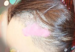 -大麦微针植发全国连锁