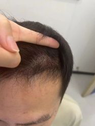-大麦微针植发全国连锁