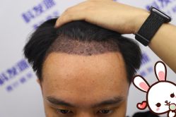 -大麦微针植发丨全国连锁