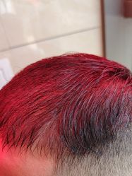 -碧莲盛·不剃发植发