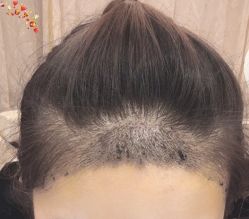 -大麦微针植发丨全国连锁