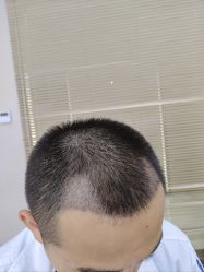 -大麦微针植发丨全国连锁