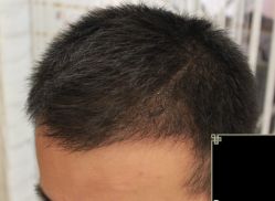 -大麦微针植发丨全国连锁