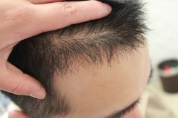 点击看大图 -大麦微针植发丨全国连锁