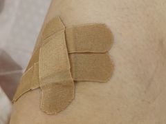 -杭州仁易堂中医康复医院疤痕修复