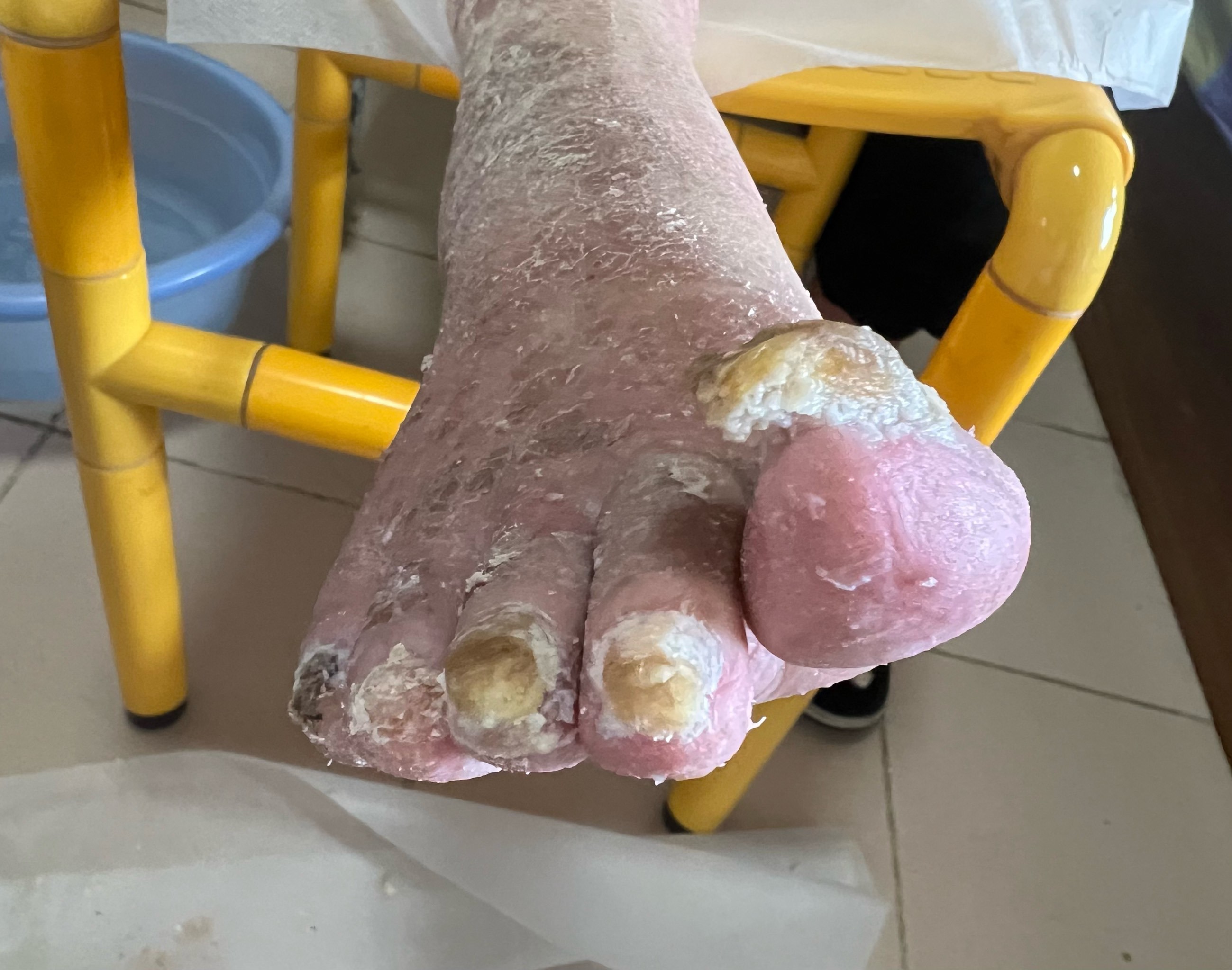 北京上门修脚服务:本人住东三环呼家楼