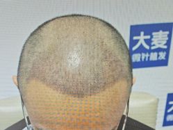 -大麦微针植发丨全国连锁