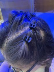 -碧莲盛·不剃发植发