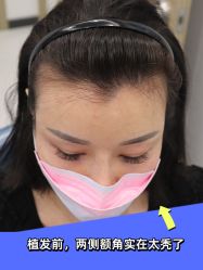 -大麦微针植发全国连锁