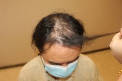 -大麦微针植发丨全国连锁