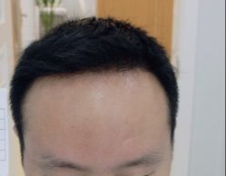 -大麦微针植发全国连锁