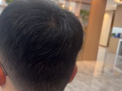 -碧莲盛·不剃发植发