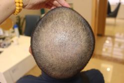 -大麦微针植发丨全国连锁