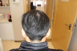 -大麦微针植发丨全国连锁