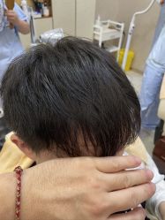 -大麦微针植发丨全国连锁