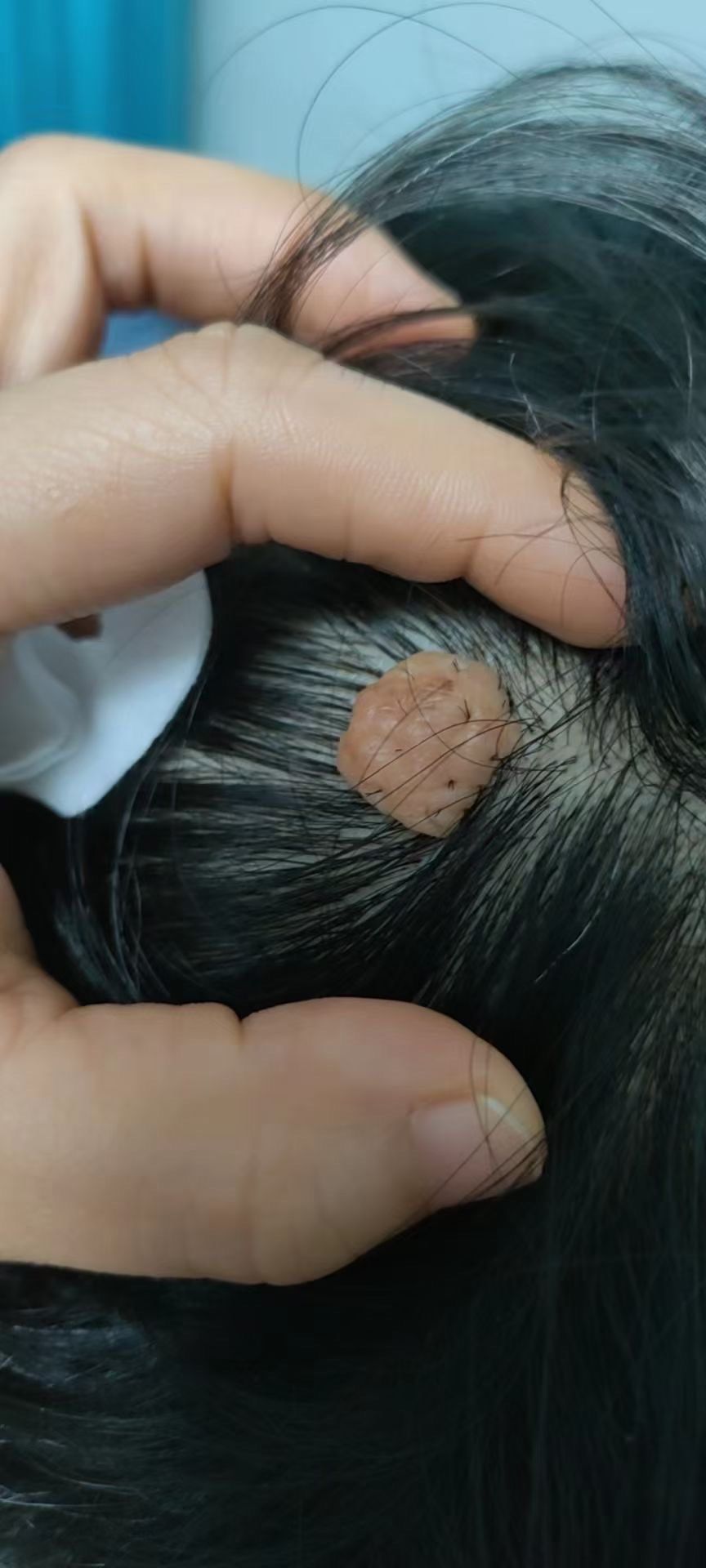 肉瘤肉痣的好去处