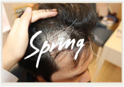 点击看大图 -大麦微针植发全国连锁