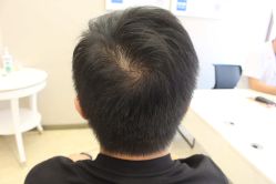 -大麦微针植发丨全国连锁