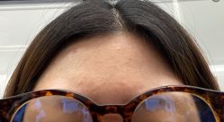 -瓷肌博士·祛痘科技美肤