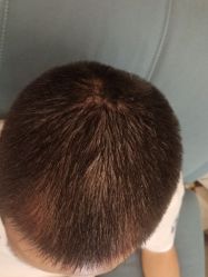 -碧莲盛·不剃发植发